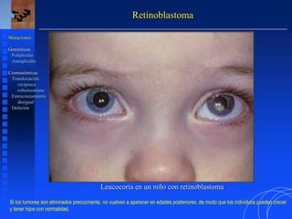 Retinoblastoma
Mutaciones
Genómicas
Poliploidía
Aneuploidía
Cromosómicas
Translocación
recíproca
robertsoniana
Entrecruzamiento
desigual
Deleción
Leucocoria en un niño con retinoblastoma
Si los tumores son eliminados precozmente, no vuelven a aparecer en edades posteriores, de modo que los individuos pueden crecer
y tener hijos con normalidad.
 
