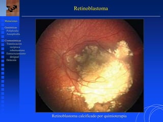 Retinoblastoma
Mutaciones
Genómicas
Poliploidía
Aneuploidía
Cromosómicas
Translocación
recíproca
robertsoniana
Entrecruzamiento
desigual
Deleción
Retinoblastoma calcificado por quimioterapia
 