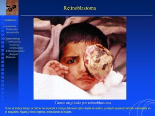 Retinoblastoma
Mutaciones
Genómicas
Poliploidía
Aneuploidía
Cromosómicas
Translocación
recíproca
robertsoniana
Entrecruzamiento
desigual
Deleción
Tumor originado por retinoblastoma
Si no se trata a tiempo, el cáncer se expande a lo largo del nervio óptico hasta el cerebro, pudiendo aparecer también metástasis en
el esqueleto, hígado y otros órganos, produciendo la muerte.
 
