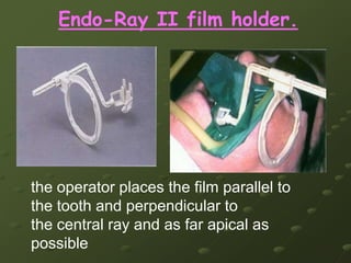 ANATOMY RALATIONSHIPS IN SITUThe maxillary 2 molar usually is more closely related to the maxillary sinus than the maxillary 1 molarThis close relationship may produce Soreness In the maxillary teeth due to Maxillary sinusities