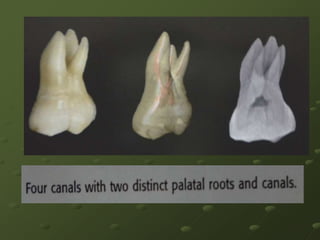 3. TROUGHING GROOVES WITH          ULTRASONIC TIPS4. STAINING THE CHAMBER WITH 1 %METHYLENE BLUE DYE    CHAMPAGNE BUPPLE TEST5. VISUALIZING CANAL BLEEDING       POINT
