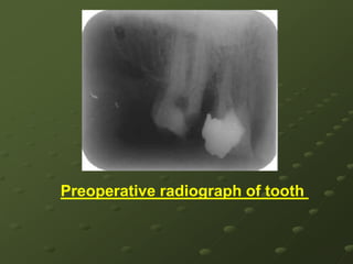 Rotated teethThis case altered crown root relationship Management of rotated teethRadiograph examination is crucial