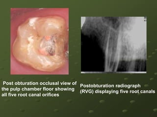 Table 1: Canal Configurations ofMaxillary second MolarYear    Author          Canal configuration                                    P        MB       DB1979   Slowey             2         1           1 1979   Thews              2         1           1 1982   Cecic                2         2           1 1983   Martinez-          1         3           2            Berna1984   Beatty               1         3           1 1988   Bond                 2         2           2 1991   Wong                3         1           1 1994   Jacobsen          2         1           1 1997   Hulsmann         1         1            2 