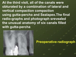 Preoperative radiograph of tooth 