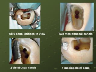 Examination of the chamber floor with an endodontic explorer (DG-16) revealed five canal orifices1.mesiobuccal canal (MB1),2.mesiobuccal 2nd canal (MB2),3.mesiopalatal canal (MP),4.distopalatal canal (DP)5.distobuccal canal (DB) 