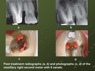 Occlusal view of seating of master point, displaying five root canal orificesOcclusal view of the access opening showing MB1, MB2, DB, and MP canal orifices