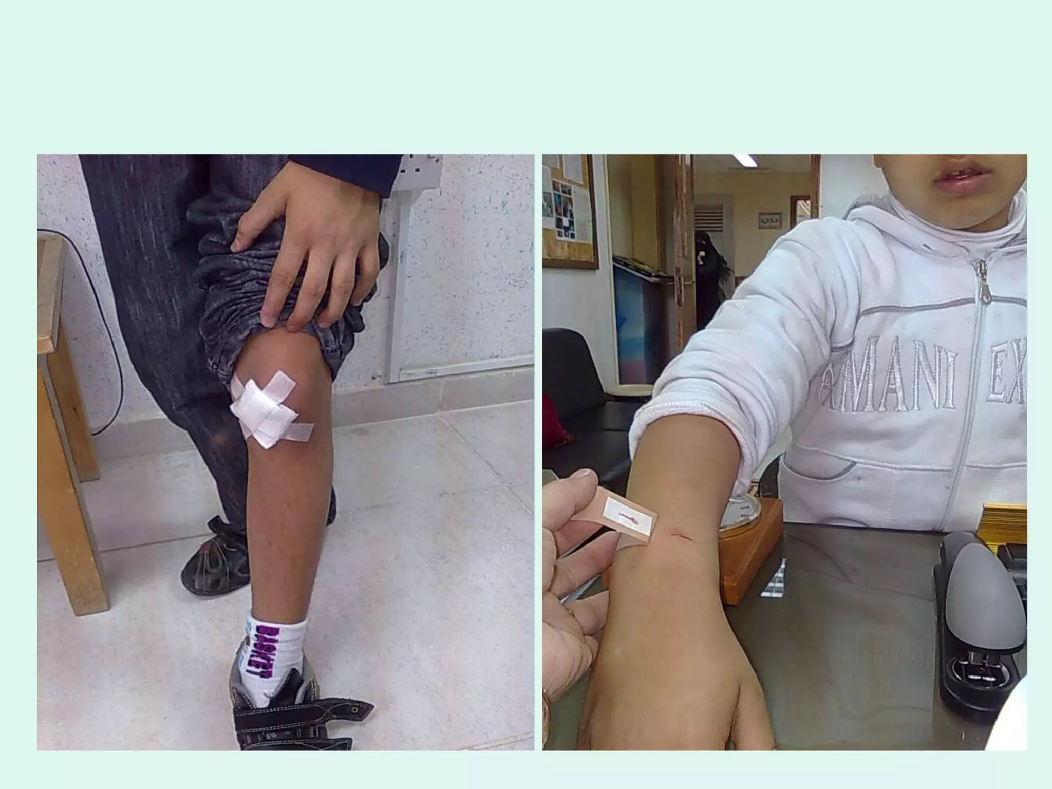 جروح وكدمات بالأيدي والأرجل