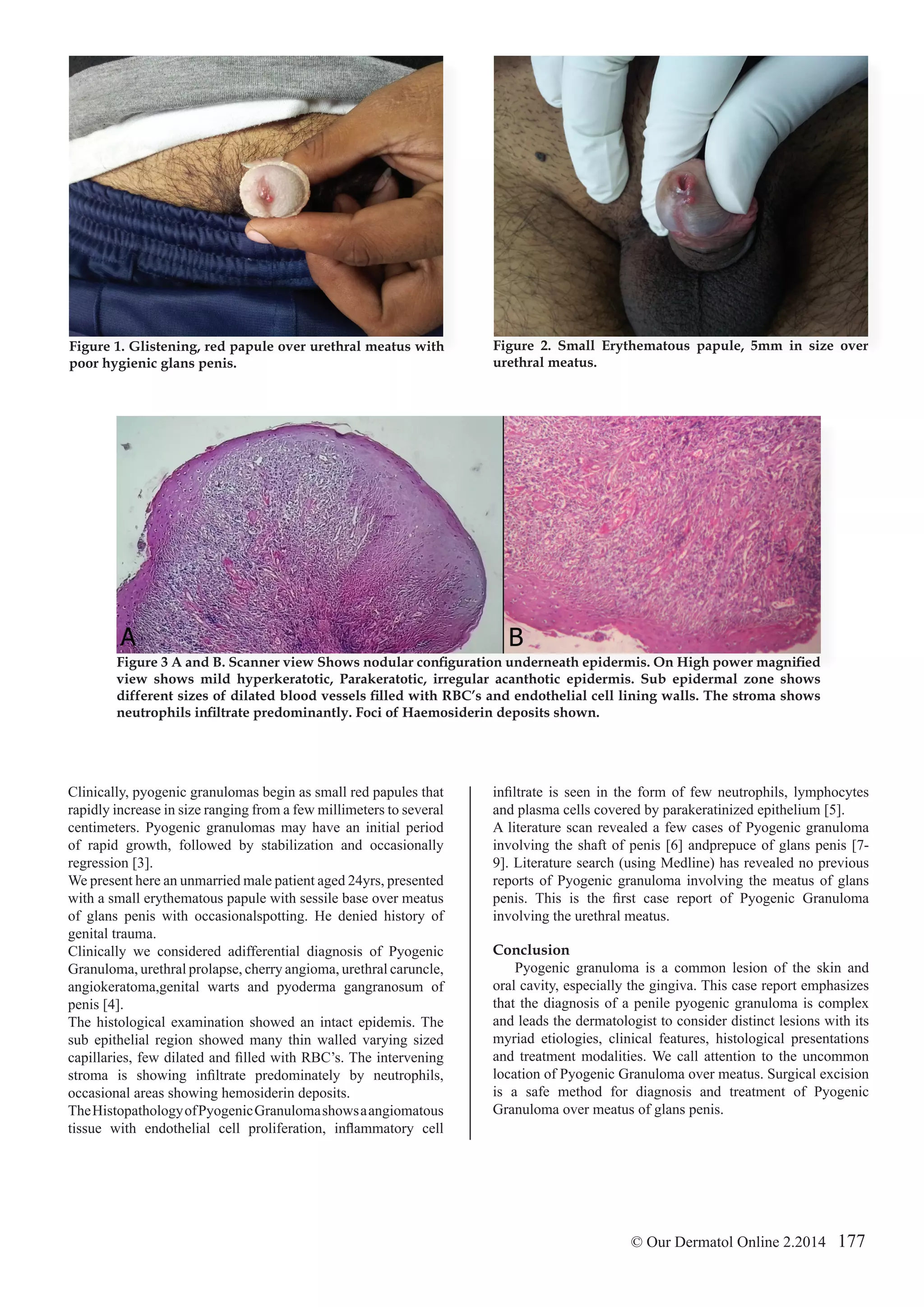 Pyogenic Granuloma Over Urethral Meatus | PDF