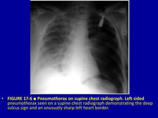 17 Thoracic Trauma and Related Topics | PPTX