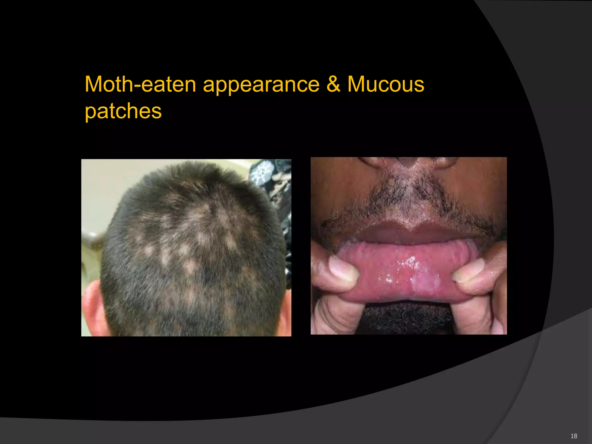 Moth-eaten appearance & Mucous
patches
18
 