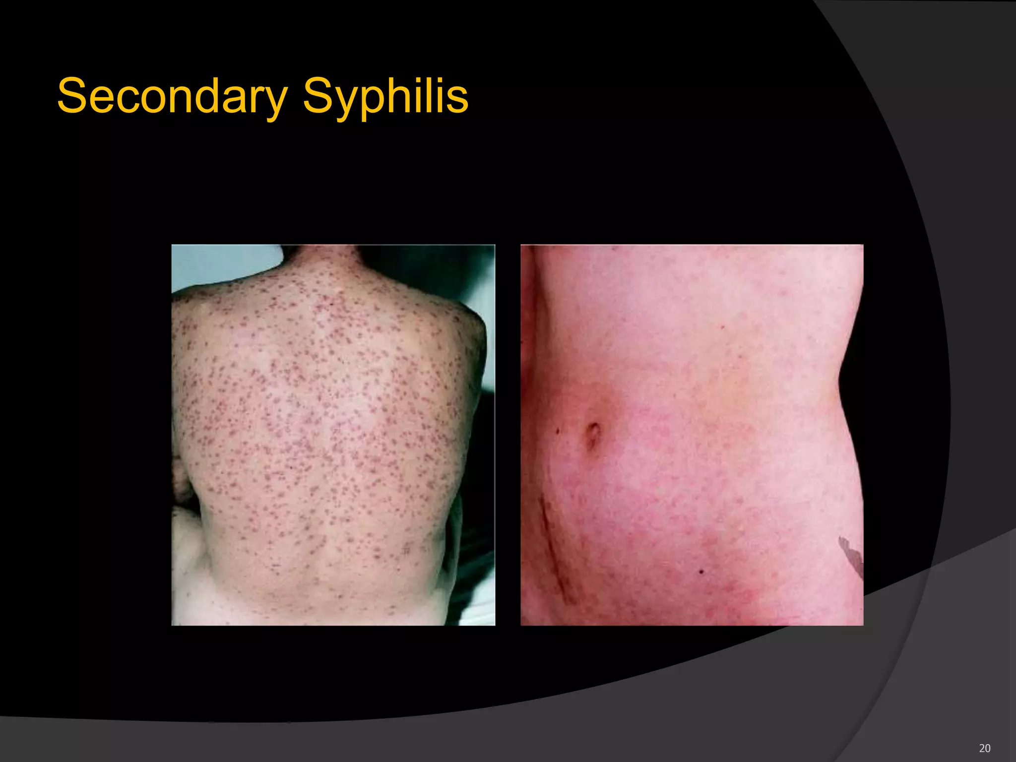 Secondary Syphilis
20
 