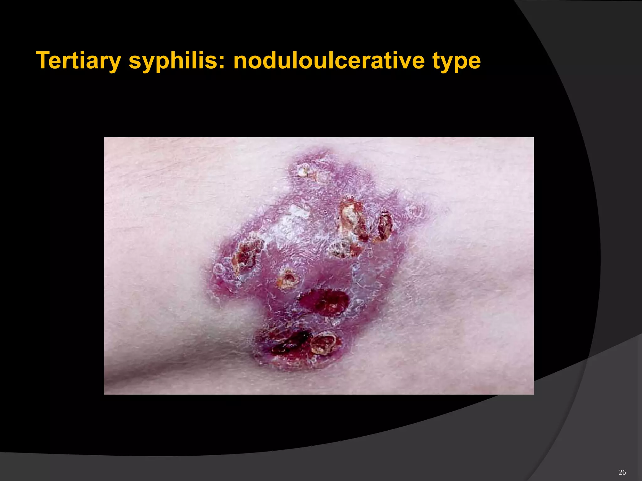 Tertiary syphilis: noduloulcerative type
26
 