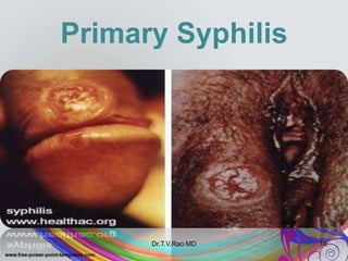 Primary Syphilis
Dr.T.V.Rao MD 16
 