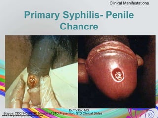 Primary Syphilis- Penile
Chancre
17
Clinical Manifestations
Source: CDC/ NCHSTP/ Division of STD Prevention, STD Clinical Slides
Dr.T.V.Rao MD
 