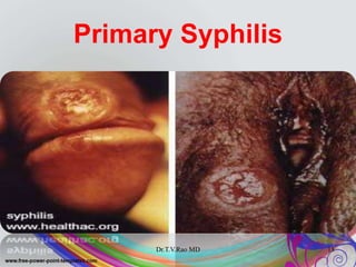 Primary Syphilis
Dr.T.V.Rao MD 18
 