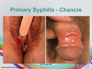 Primary Syphilis - Chancre
Dr.T.V.Rao MD 19
 