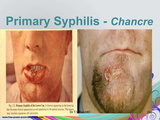 Primary Syphilis - Chancre
Dr.T.V.Rao MD 20
 