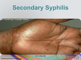 Secondary Syphilis
Dr.T.V.Rao MD 23
 