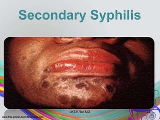 Secondary Syphilis
Dr.T.V.Rao MD 24
 