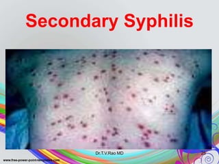 Secondary Syphilis
Dr.T.V.Rao MD 25
 