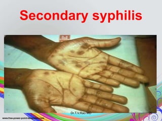 Secondary syphilis
Dr.T.V.Rao MD 26
 