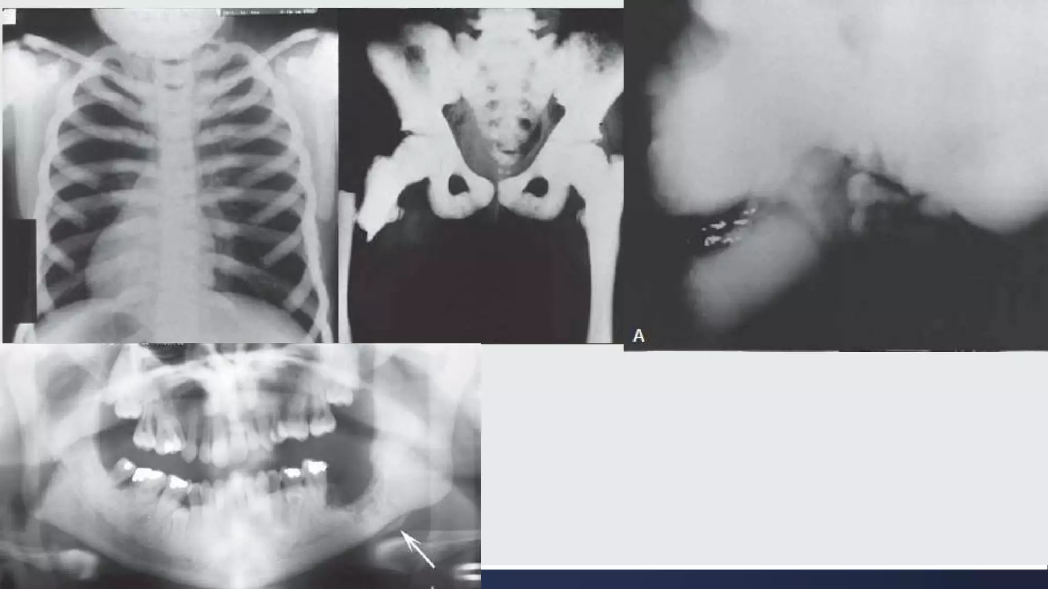 Radiographic Interpretation of Systemic Diseases Manifestations in the ...
