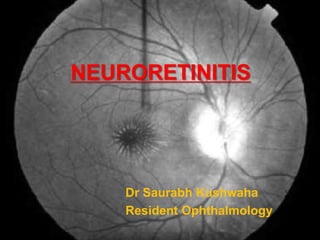 NEURORETINITIS
Dr Saurabh Kushwaha
Resident Ophthalmology
 