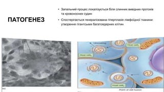 ПАТОГЕНЕЗ
• Запальний процес локалізується біля слинних вивідних протоків
та кровоносних судин
• Спостерігається генералізована гіперплазія лімфоїдної тканини:
утворення гігантських багатоядерних клітин
 
