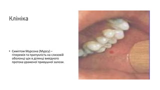 Клініка
• Симптом Мурсона (Мурсу) –
гіперемія та припухлість на слизовій
оболонці щік в ділянці вивідного
протока ураженої привушної залози.
 
