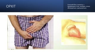 ОРХІТ
Сильний біль в калитці, з
іррадіацією в пах, поперек, яєчко
збільшується, ущільнюється.
 