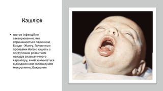 Кашлюк
• гостре інфекційне
захворювання, яке
спричинюється паличкою
Борде - Жангу. Головними
проявами його є кашель з
поступовим розвитком
нападів спазматичного
характеру, який закінчується
відходженням скловидного
мокротиння, блювання
 