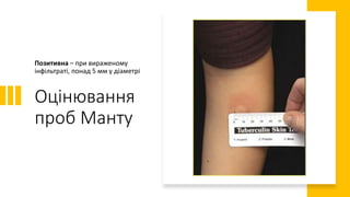 Оцінювання
проб Манту
Позитивна – при вираженому
інфільтраті, понад 5 мм у діаметрі
 
