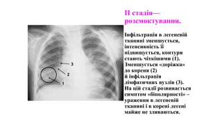 II стадія—
розсмоктування.
Інфільтрація в легеневій
тканині зменшується,
інтенсивність її
підвищується, контури
стають чіткішими (1).
Зменшується «доріжка»
до кореня (2)
й інфільтрація
лімфатичних вузлів (3).
На цій стадії розвивається
симптом «біполярності» –
ураження в легеневій
тканині і в корені легені
майже не зливаються.
1
2
3
 