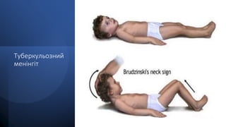 Туберкульозний
менінгіт
 