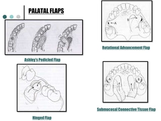 Single Rotation Flap 17. Maxillary sinus, antrum of highmore, surgical anatomy | PPTX
