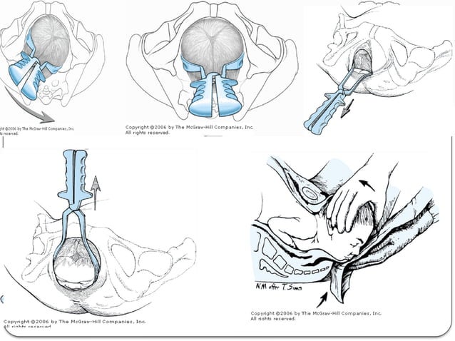 Using Forceps During Delivery OPERATIVE VAGINAL DELIVERY FORCEPS AND V | PPT