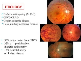 ETIOLOGY
Diabetic retinopathy (M.C.C)
CRVO/CRAO
Ocular ischemic disease
Carotid artery occlusive disease
• 36% cases : arise from CRVO
• 32% : proliferative
diabetic retinopathy
• 13% : carotid artery
occlusive disease 13
 