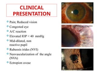 CLINICAL
PRESENTATION
 Pain; Reduced vision
 Congested eye
 A/C reaction
 Elevated IOP < 40 mmHg
 Mid-dilated, non
reactive pupil
 Rubeosis irides (NVI)
 Neovascularization of the angle
(NVA)
 Ectropion uveae
 