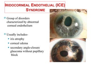 IRIDOCORNEAL ENDOTHELIAL (ICE)
SYNDROME
 Group of disorders
characterized by abnormal
corneal endothelium
 Usually includes-
⚫ iris atrophy
⚫ corneal edema
⚫ secondary angle-closure
glaucoma without pupillary
block
 