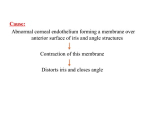 Cause:
Abnormal corneal endothelium forming a membrane over
anterior surface of iris and angle structures
Contraction of this membrane
Distorts iris and closes angle
 