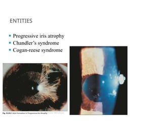 ENTITIES
⚫ Progressive iris atrophy
⚫ Chandler’s syndrome
⚫ Cogan-reese syndrome
 