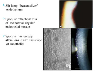  Slit-lamp: ‘beaten silver’
endothelium
 Specular reflection: loss
of the normal, regular
endothelial mosaic
 Specular microscopy:
alterations in size and shape
of endothelial
42
 