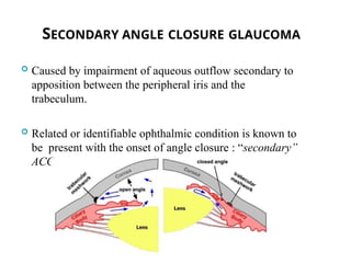 SECONDARY ANGLE CLOSURE GLAUCOMA
 Caused by impairment of aqueous outflow secondary to
apposition between the peripheral iris and the
trabeculum.
 Related or identifiable ophthalmic condition is known to
be present with the onset of angle closure : “secondary”
ACG
3
 