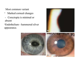 Most common variant
- Marked corneal changes
- Corectopia is minimal or
absent
-Endothelium - hammered silver
appearance.
 