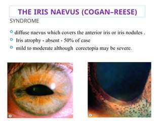 THE IRIS NAEVUS (COGAN–REESE)
SYNDROME
 diffuse naevus which covers the anterior iris or iris nodules .
 Iris atrophy - absent - 50% of case
 mild to moderate although corectopia may be severe.
 