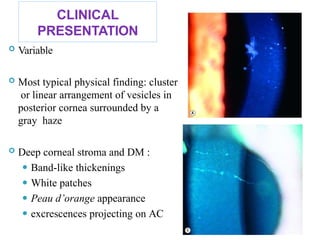 CLINICAL
PRESENTATION
 Variable
 Most typical physical finding: cluster
or linear arrangement of vesicles in
posterior cornea surrounded by a
gray haze
 Deep corneal stroma and DM :
⚫ Band-like thickenings
⚫ White patches
⚫ Peau d’orange appearance
⚫ excrescences projecting on AC
 