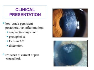 CLINICAL
PRESENTATION
 low-grade persistent
postoperative inflammation:
⚫ conjunctival injection
⚫ photophobia
⚫ Cells in AC
⚫ discomfort
 Evidence of current or past
wound leak
61
 