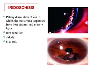 IRIDOSCHISIS
 Patchy dissolution of iris in
which the ant stroma separates
from post stroma and muscle
layer
 rare condition
 elderly
 bilateral.
 