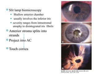  Slit lamp biomicroscopy
⚫ Shallow anterior chamber
⚫ usually involves the inferior iris
⚫ severity ranges from intrastromal
atrophy to disintegrated iris fibrils
 Anterior stroma splits into
strands
 Project into AC
 Touch cornea
 