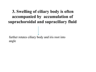 3. Swelling of ciliary body is often
accompanied by accumulation of
suprachoroidal and supraciliary fluid
further rotates ciliary body and iris root into
angle
 